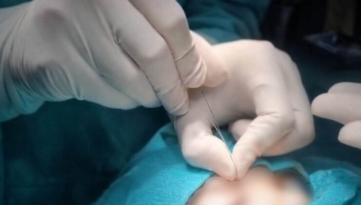 Çukurca’da gözyaşı kanalı ameliyatları yapılmaya başlandı