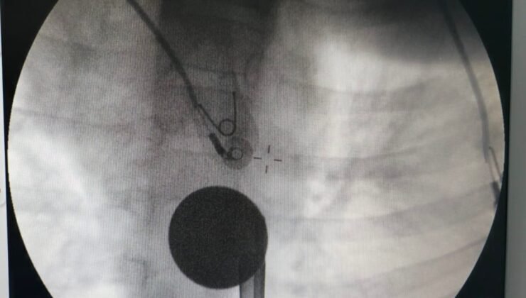 Siirt’te boğazına madeni para kaçan çocuk, doktorların müdahalesi ile kurtarıldı